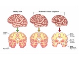 認知症の原因は脳の“お掃除機能”の低下