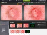 カシオ、秘伝のデジカメ技術を「皮膚癌診断」へ