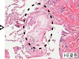 がんと特発性肺線維症と拡張障害型心不全に共通する分子は?