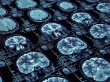 アイルランドProthena社、ADに対する抗体医薬の開発の進捗状況をAAICで発表