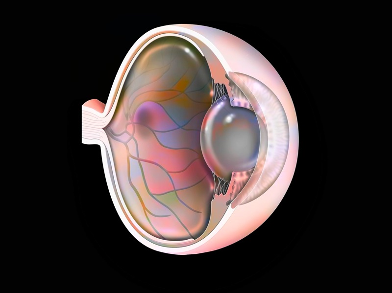 BI社、AMDの重症型である地図状萎縮に経口リン脂質修飾薬の第2相臨床